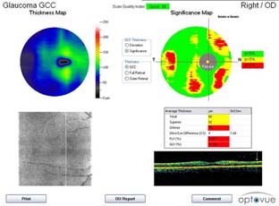 Spektrální optická koherentní tomografie /SOCT/