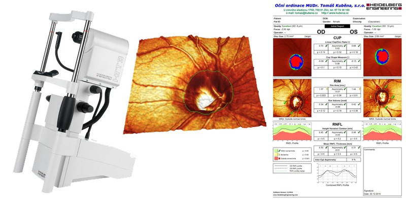 Konfokální skenovací laserová oftalmoskopie – HRT