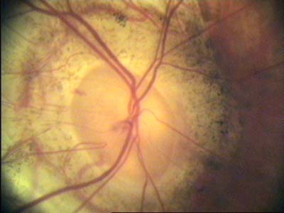 Glaukom - myopický typ