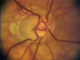 cévy a poškození terče glaukomem