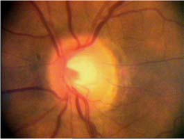 Můžeme z nálezu na terči potvrdit glaukom?