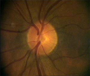variabilita vzhledu terče zrakového nervu - 99%