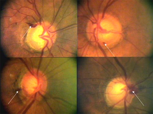 Peripapilární hemorhagie u glaukomu