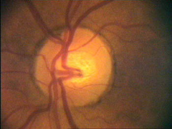 zrakový nerv na očním pozadí